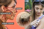 Hmyz nám může pěkně znepříjemnit život