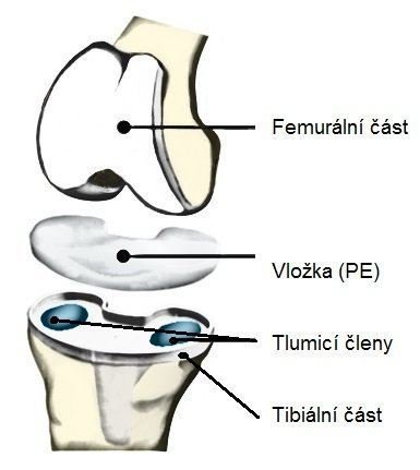 Schéma celkové sestavy kloubního implantátu.