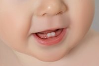 Nepřehánějte to s fluorem u dětí, způsobuje fleky na zubech