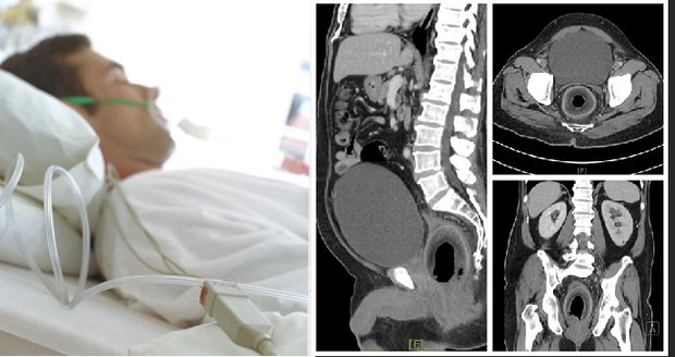 vlevo ilustrační foto, vpravo CT snímek pacienta s kokosem v análním otvoru