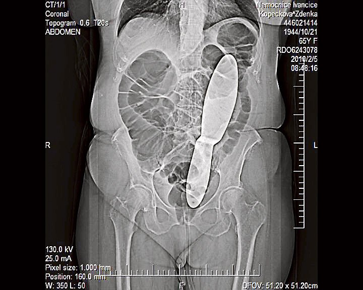 Rentgenový snímek, který zachycuje špachtli v břiše