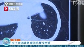 Čínskému mladíkovi se do plic dostal parazit, který mu nyní způsobuje vážné dýchací obtíže.