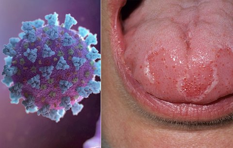 Lékař odhalil dosud neznámý příznak koronaviru: Takhle vypadá „covidový jazyk“