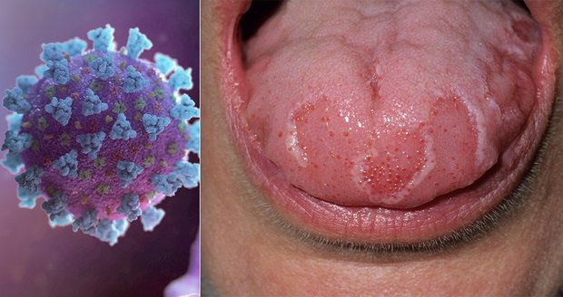 Lékař odhalil dosud neznámý příznak koronaviru: Takhle vypadá „covidový jazyk“