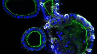 Vědci zjistili, že nový koronavirus napadá i střevní buňky