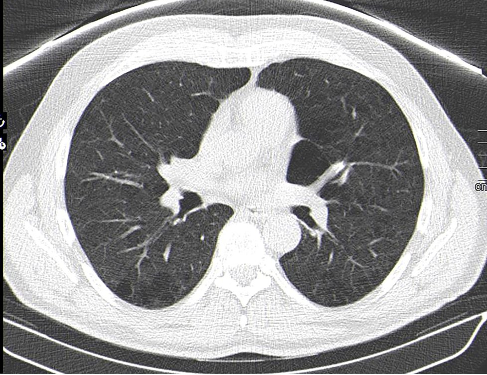 Plíce pacientky vyléčené z koronaviru