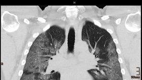 Plíce pacienta nakaženého koronavirem