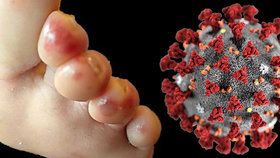 Pozor na „covidové prsty“, vyrážka by mohla být jediným příznakem nákazy koronavirem