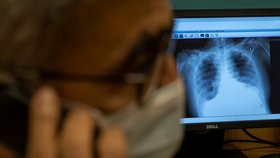 Rakouští i čeští lékaři tvrdí, že u pacientů s koronavirem se ještě 3 měsíce po propuštění z nemocnice vyskytuje poškození plic, (ilustrační foto).