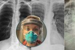 Plíce po covidu-19 jsou víc zničené, než plíce letitých kuřáků, varuje lékařka.