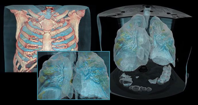 Jak vypadají plíce poškozené koronavirem? Lékaři vytvořili model plic nemocného pacienta