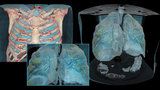 Šokující model lékařů: Takhle vypadají plíce poškozené koronavirem