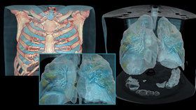 Jak vypadají plíce poškozené koronavirem? Lékaři vytvořili model plic nemocného pacienta