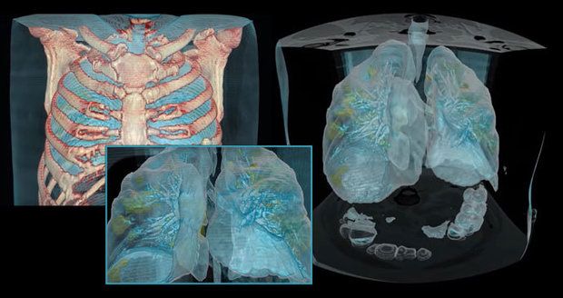 Šokující model lékařů: Takhle vypadají plíce poškozené koronavirem