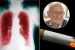 Pan Zdeněk si kouřením zcela zdevastoval plíce. Projevila se mu chronická obstrukční plicní nemoc (CHOPN).