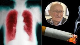 Zdeněk kouřil 40 cigaret denně, dostal zákeřnou chorobu plic. Až třetina Čechů jí trpí