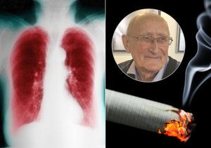 Pan Zdeněk si kouřením zcela zdevastoval plíce. Projevila se mu chronická obstrukční plicní nemoc (CHOPN).