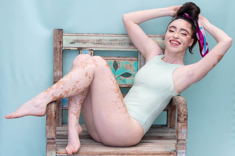 Stephanie Yashimuraová (28) trpí kožní poruchou zvanou vitiligo.