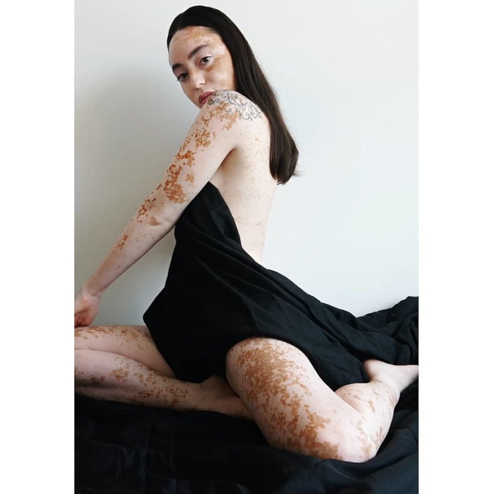 Stephanie Yashimuraová (28) trpí kožní poruchou zvanou vitiligo.