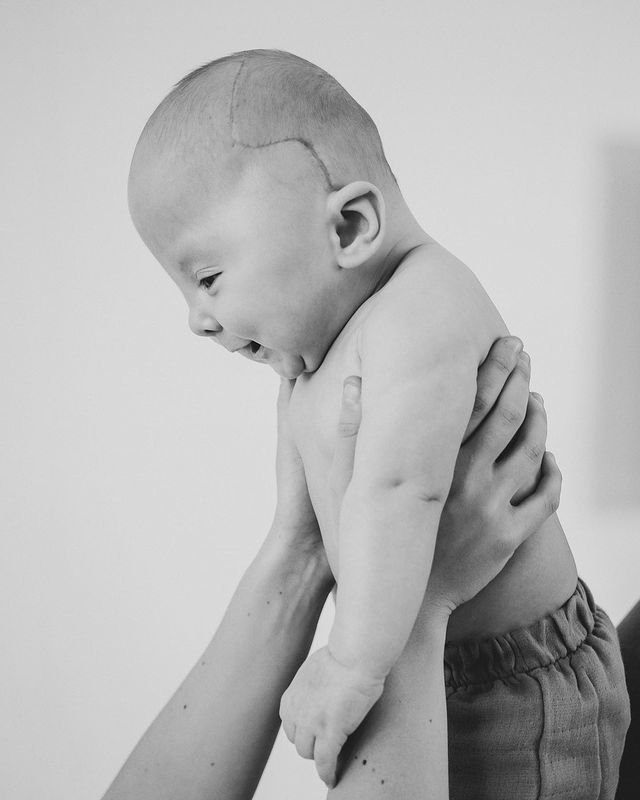 Malý Flex Dan se narodil s takzvanou kraniosynostózou.