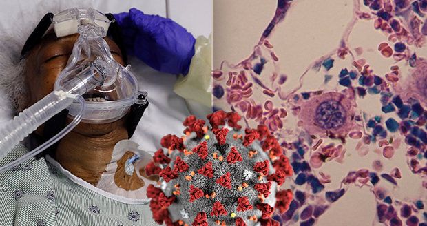 Převratný objev Němců u koronaviru? Krevní testy mají předem odhalit těžké případy