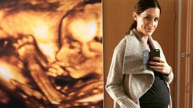 Lucie Křížková ukázala ultrazvuk svého miminka.