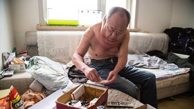 Číňan Wang Č’-siang musí žít s obřím krkem kvůli chybě lékařů.
