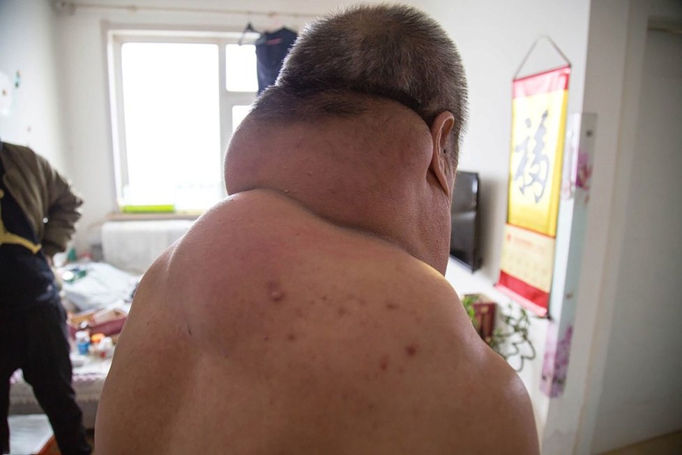 Číňan Wang Č’-siang musí žít s obřím krkem kvůli chybě lékařů.