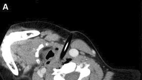 CT snímky zranění, při kterém se 11leté školačce zabodla tužka do krku.