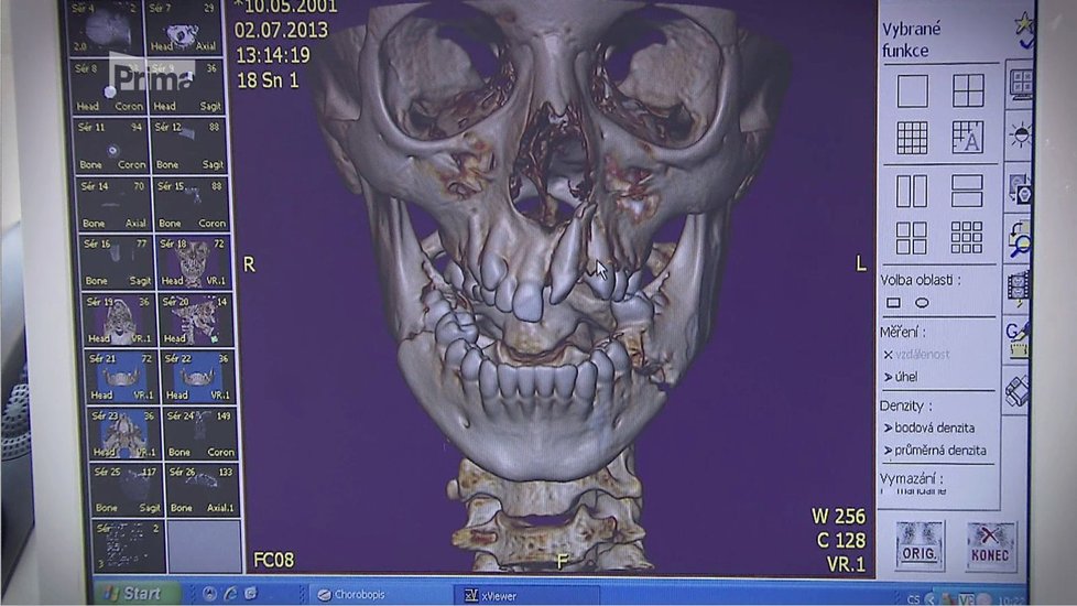 Výsledek vyšetření na počítačové tomografii.