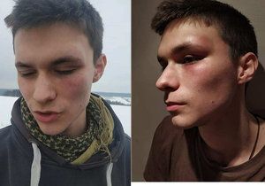 Drsný útok řidiče subaru na mladého kurýra ve Dvoře Králové: Honza (19) skončil s oteklým okem a otřesem mozku