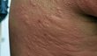 Takto vypadá kopřivka neboli alergická reakce kůže