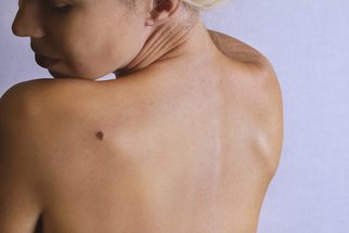 Melanom: Rakovina kůže, která postihuje stále více lidí. Jak jej poznáte?