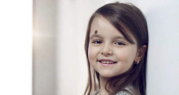 U dětí se stále častěji objevuje zhoubný melanom. Jak ho poznat? 