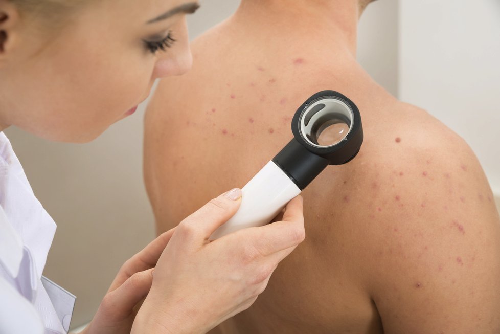 Základ je minimálně jednou za rok přijít k dermatologovi, aby se na znaménka podíval. To je to první a nejdůležitější, radí dermatoložka Jiráková.