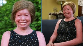 Dívka (18) trpí vzácnou kožní chorobou: Vypadá jako popálená