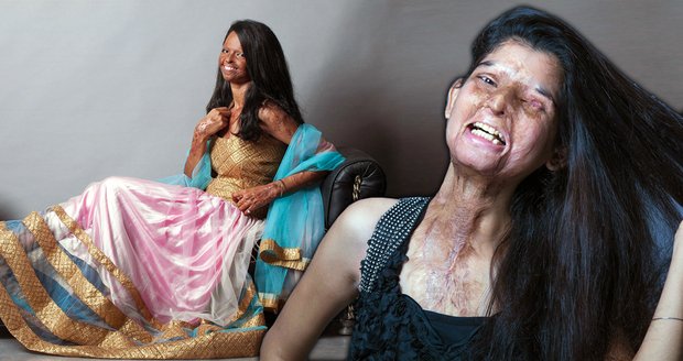 Oběti kyselinových útoků jako modelky: Krása nám ještě zbyla!
