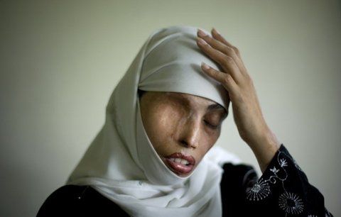 Oko za oko: Írán nařídil oslepit ženu. Kyselinou připravila sokyni o zrak 