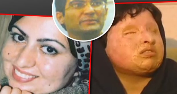 Neunesl odmítnutí, znetvořil ji kyselinou... Ameneh Bahrami před a po činu Maschida Mowahediho. Nechtěla ho, tak na ni vylil kyselinu a tím jí sebral světlo a znetvořil ji.