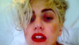 Lady Gaga utrpěla srážku při tanečních kreacích při koncertě na Novém Zélandu, po které se ji vybarvil obličej. Snímkem se hned chlubila na Twitteru.