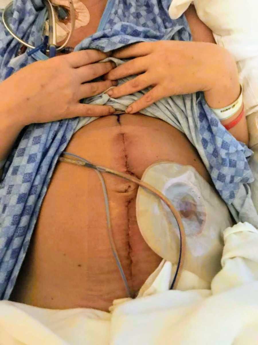 Po operaci se mladá maminka probudila s rozřezaným břichem a vyvedenou stomií.