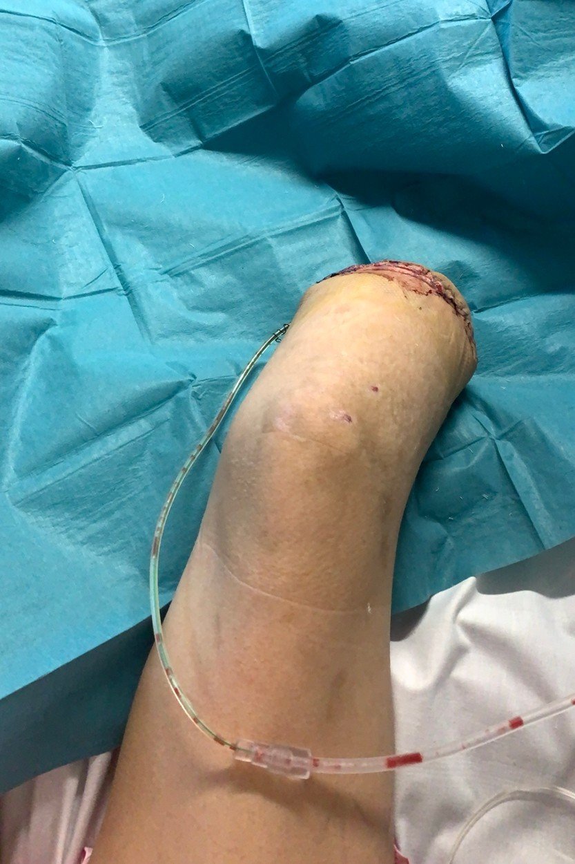 Recepční (25) se ve vířivce nakazila nebezpečnou bakterii: Museli jí amputovat nohu!