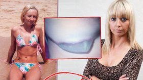Šokující! Ženě prsní implantát protrhl kůži, trčel jí ven z těla
