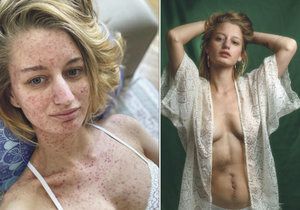 Fotografka slavných Lucie Levá (28) bojuje s rakovinou tlustého střeva.