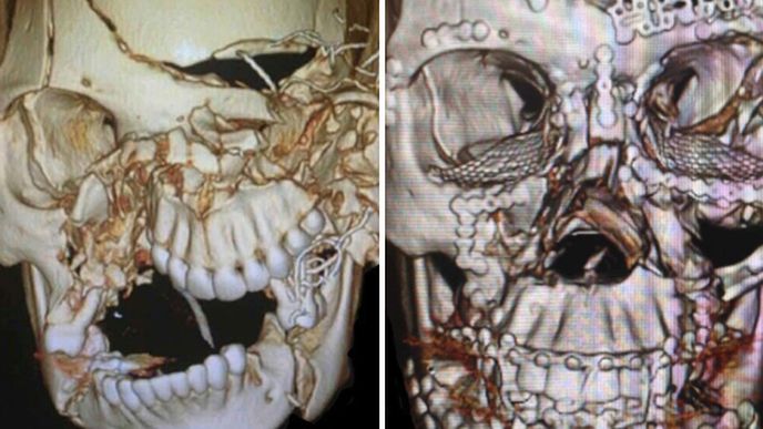 Lebka 25leté ženy vlevo na snímku ukazuje, jak vypadala po nehodě, vpravo pak zrekonstruovaný obličej po precizním zákroku lékařů. 