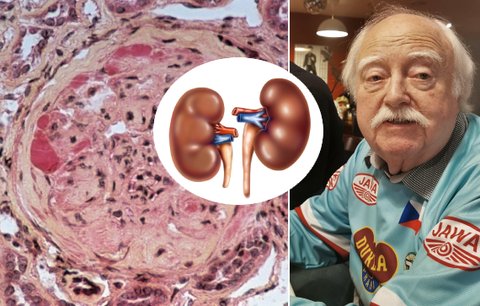 Jiří (72) podcenil cukrovku: Nemoc ho málem připravila o nohu a poškodila mu ledviny