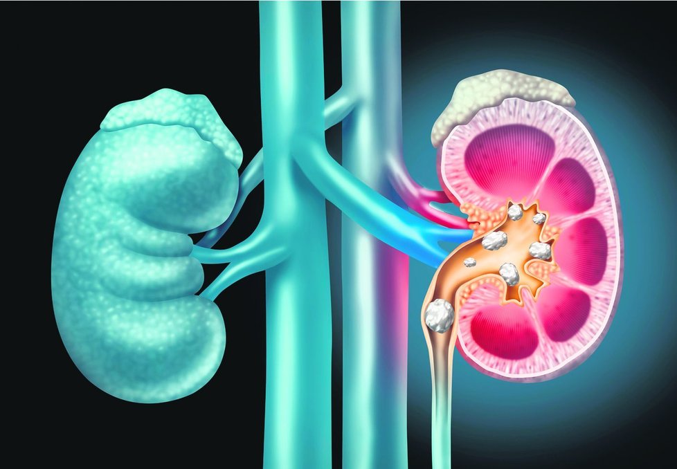 Kameny se tvoří v ledvinách  i proto, že potrava obsahuje  mnoho bílkovin a vápníku.