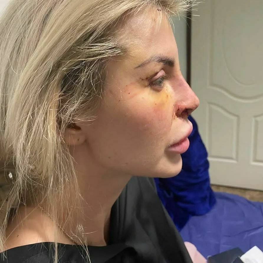Lela krátce po operaci v Iránu, kde jí potřetí upravovali nos.