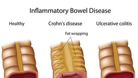 Chronické záněty střev: Vlevo zdravé střevo, uprostřed Crohnova choroba, vpravo Ulcerózní kolitida