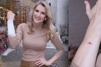 Smolařka z Primy Lenka Špillarová: Nejdřív operace, teď popáleniny!